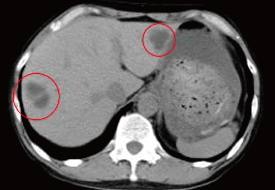 大腸がん 治療前のCTの所見