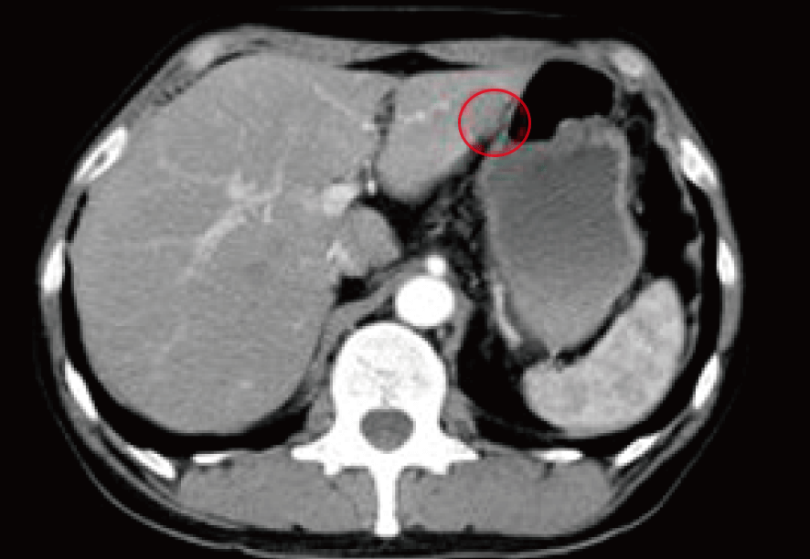 大腸がん 治療後