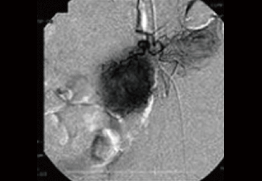 大腸がん 治療前のCTの所見