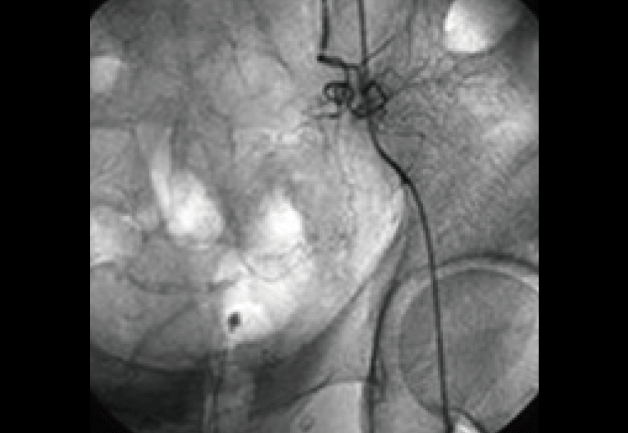 大腸がん 治療後