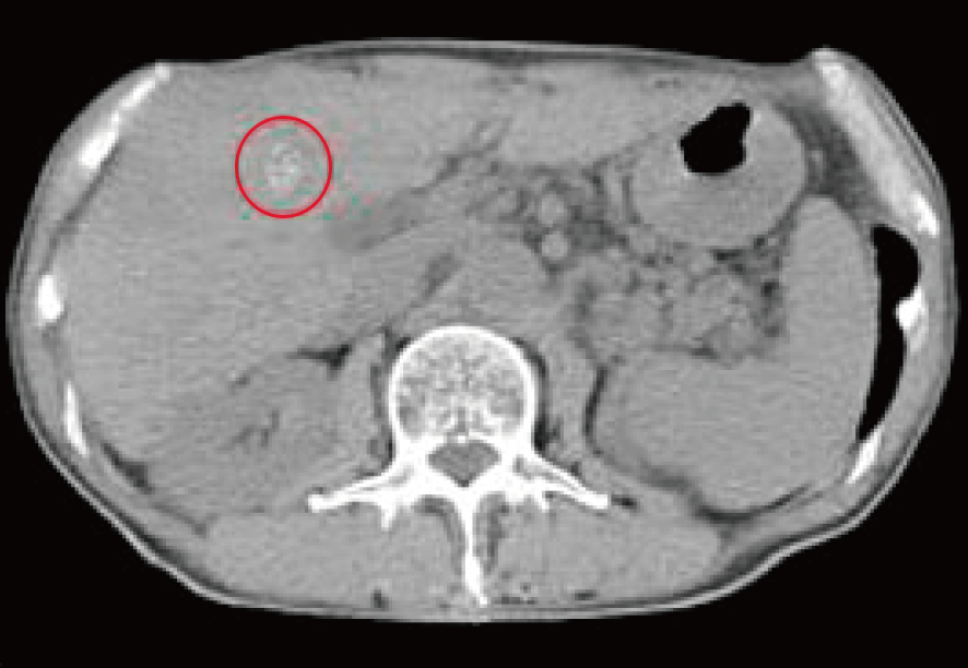 肝臓がん 治療後