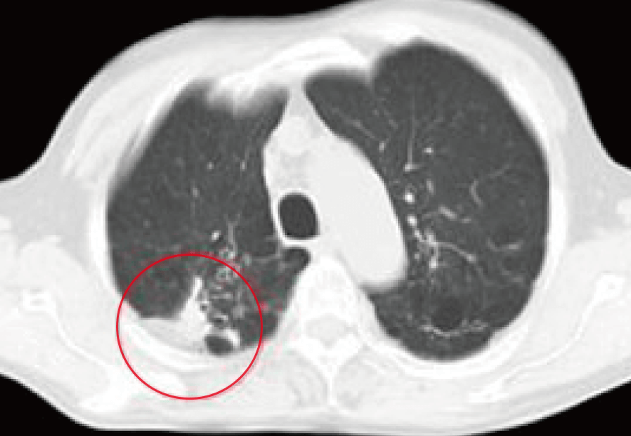 肺がん 治療前のCTの所見