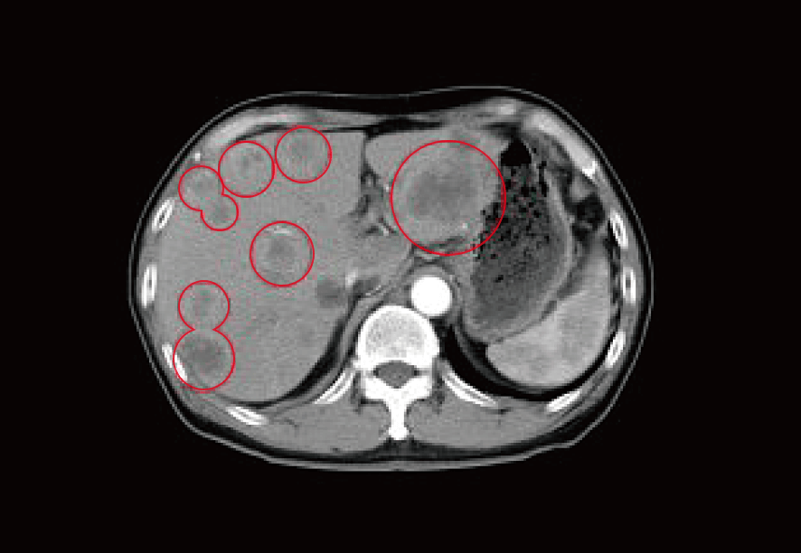 すい臓がん 治療前のCTの所見