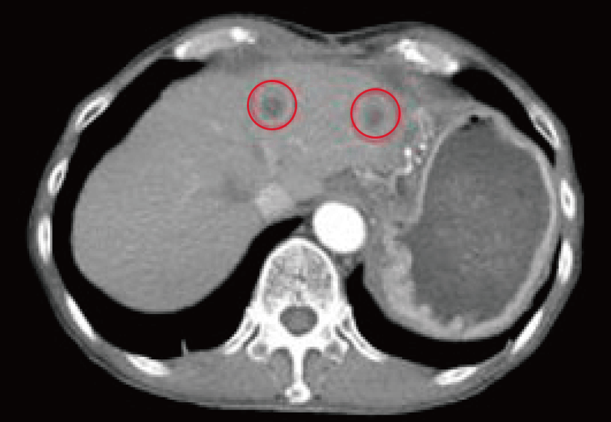 すい臓がん 治療前のCTの所見