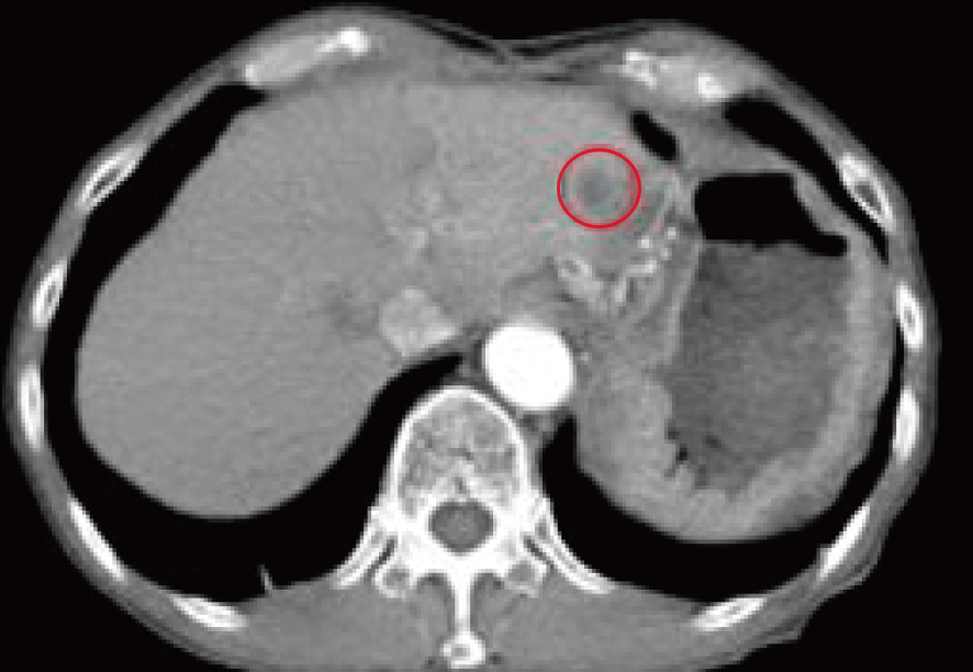 すい臓がん 治療後