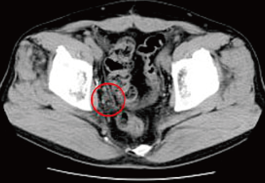 前立腺がん 治療前のCTの所見