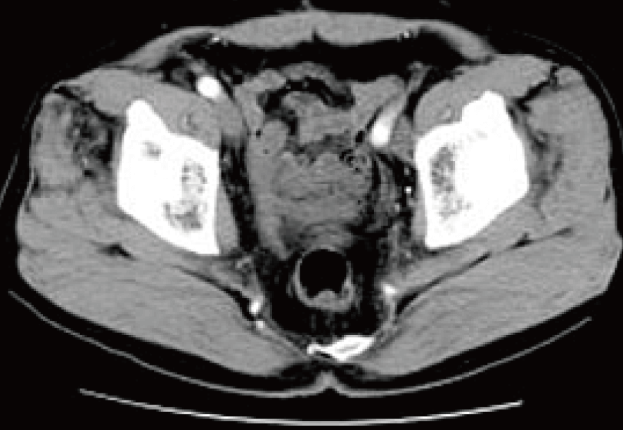 前立腺がん 治療後