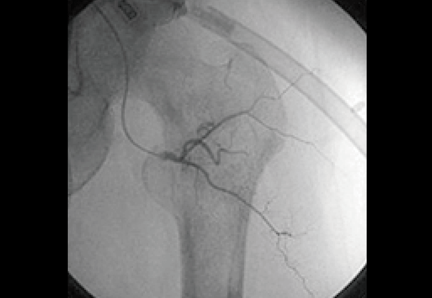 前立腺がん 治療後