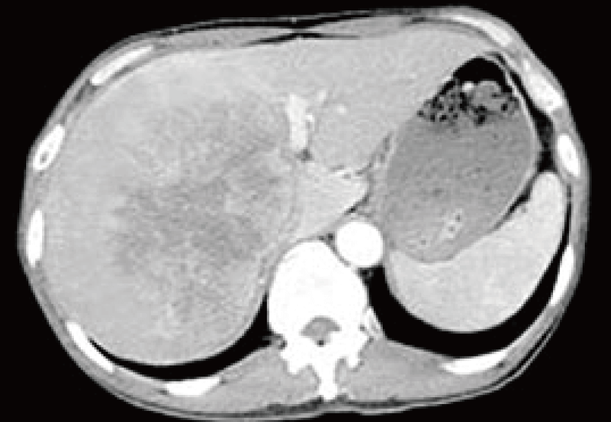 胃がん 治療前のCTの所見